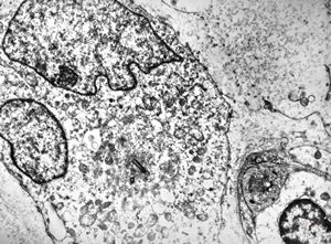 F,55y. | leiomyosarcoma - omentum